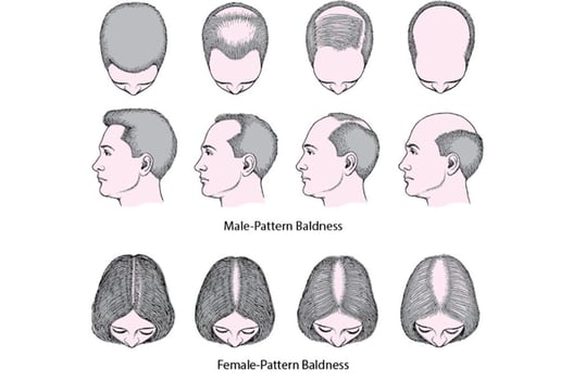 male-vs-female-pattern-baldness-1024x683