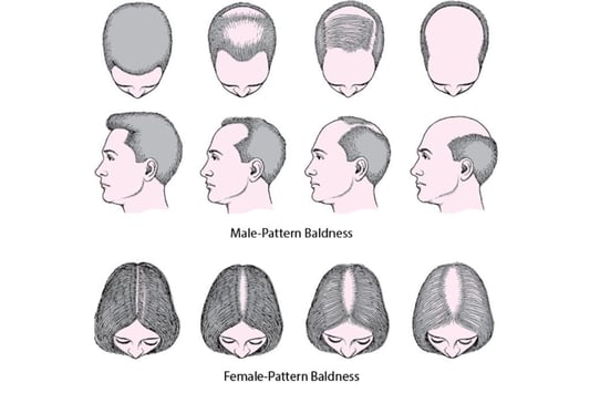 male-vs-female-pattern-baldness-1024x683