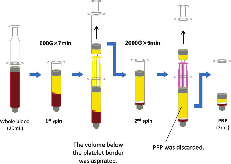 PRP-preparation-with-the-KYOCERA-Medical-PRP-Kit-2-session-centrifugation-method-is