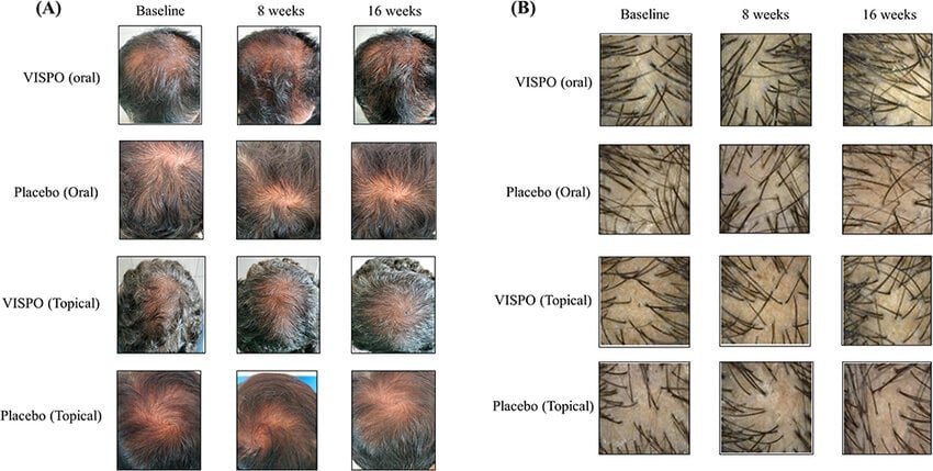 Representative-images-showing-the-changes-in-scalp-hair-following-16-week-treatment-with
