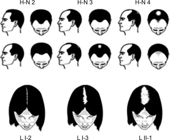 The-Hamilton-Norwood-H-N-and-Ludwig-L-scale-ranges-used-in-the-study-for-men-and